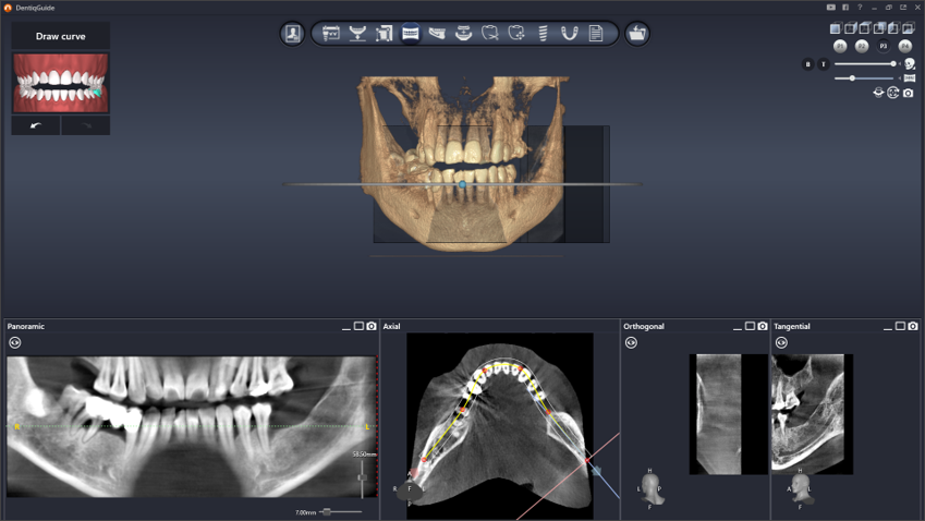 DentiqGuide Implant Planning & Design Software